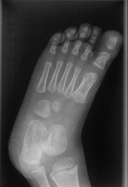 Normal Foot Xray Child