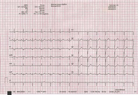 Normal Ecg Paper