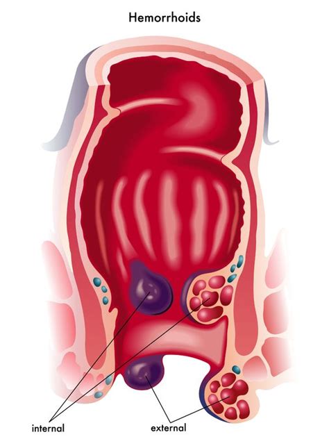 Hemorrhoids: causes, symptoms, treatment and complications