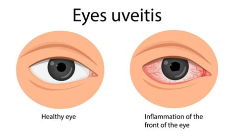 Uveitis Guide: Types, Symptoms, Causes, and Treatments | MyVision.org ...