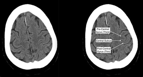 Postcentral Gyrus Mri