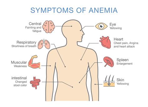 Iron Deficiency Anemia Symptoms