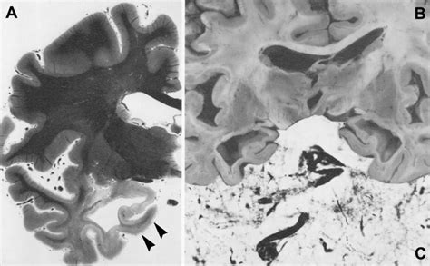 Medial temporal lobe atrophy in AD. a, b Hippocampus atrophy with ...