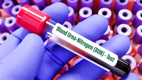 Blood Urea Nitrogen (BUN) Test: What Elevated Levels Indicate?