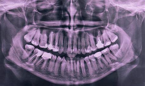 X-ray of the Oral Cavity with Teeth. Panoramic Dental X-ray ...