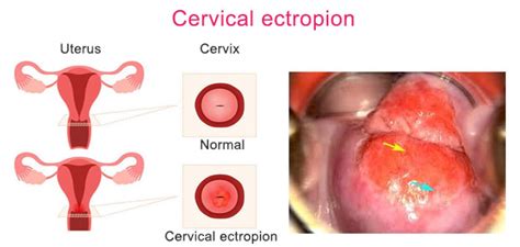 Cervical Ectropion or Cervical Erosion - Dr. Suparna Banerjee