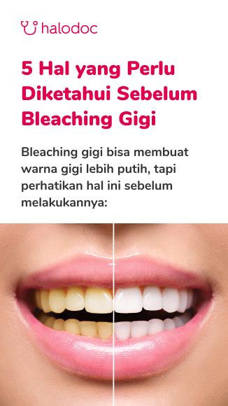 Berapa Lama Bleaching Gigi dapat Bertahan?