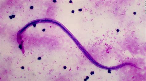 Elefantiasis Filarial; Filariasis Linfática; Filariasis de Bancroft ...