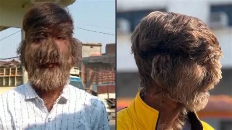 Teen born with 'Werewolf Syndrome' was covered in hair immediately ...