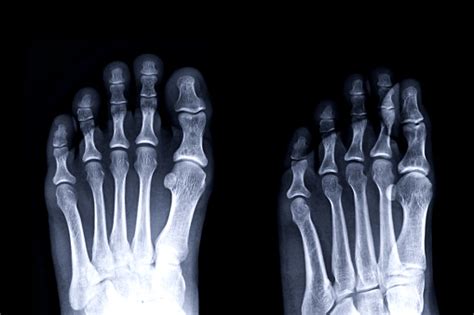 Film Xray Image Of Left Toe Front And Oblique View For Diagnosis Gouty ...