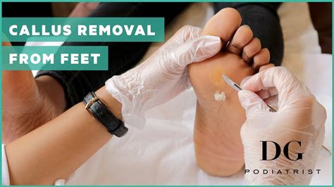 Foot Callus Remover Remedies – Foot Care Tips