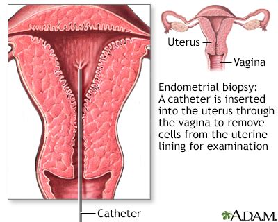 Endometrial biopsy Information | Mount Sinai - New York