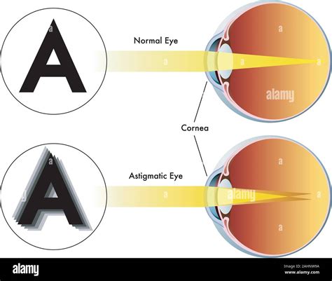 What Is Astigmatism Astigmatism Test Astigmatism Symptoms | Images and ...