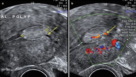 Ultrasound Evaluation of Endometrium | Obgyn Key