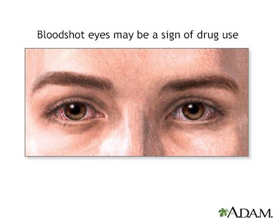 HIE Multimedia - Signs of drug use