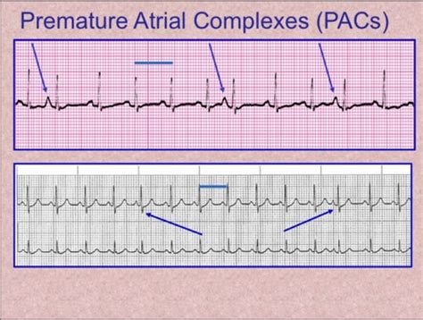 Sinus rhythm with pac ecg 671152-Sinus rhythm with pac treatment