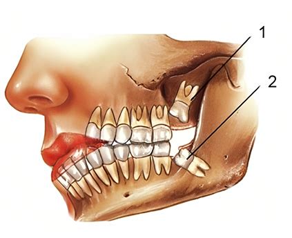 Wisdom Teeth Removal in Sydney - Sydney Dental Surgeons