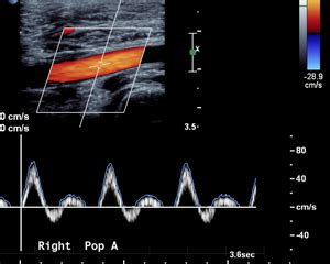 Vascular Ultrasound — Cardiology Associates of New Brunswick & Edison, NJ