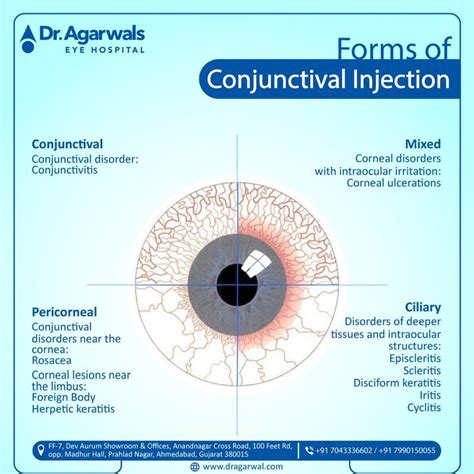 Conjunctivitis, Rosacea, Disorders