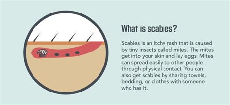 Scabies – Symptoms and Treatment – Healthy Food Near Me