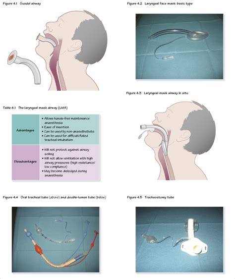 4: Airway devices | Pocket Dentistry