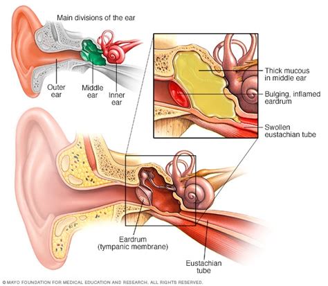 Ear infection - Mayo Clinic