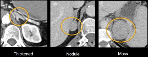 Abdominal CT: spleen and adrenal glands • LITFL • Radiology