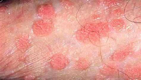 Genital warts - Summerlin Dermatolo­gy