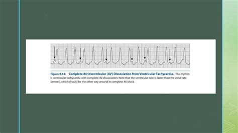 Atrio-Ventricular Dissociation - causes with ECG examples | PPT