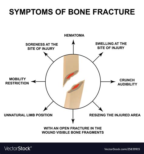 Symptoms bone fracture Royalty Free Vector Image