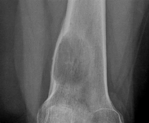 Osteosarcoma | Radiology Case | Radshare.net