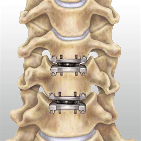 Neck disc surgery in Iran at Erfan Hospital - irantreatments