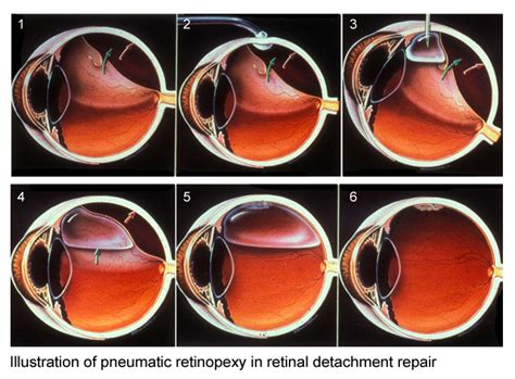 retinal-surgery | Advanced Vision Technologies of Trinidad and Tobago