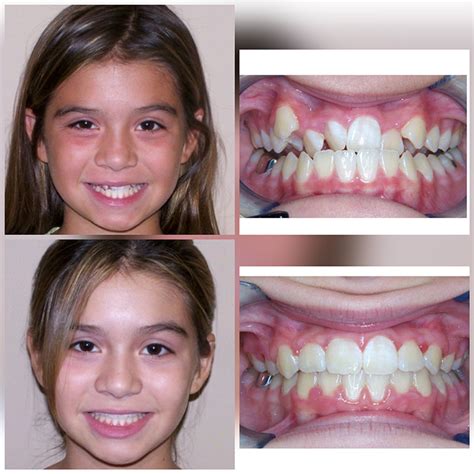 Before & After Braces | Wazio Orthodontics