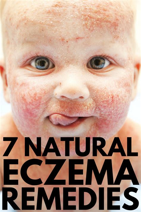 Natural eczema treatment: 7 natural ways to treat eczema that work!