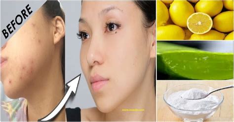 How To Remove Pimple Marks 5 Natural Home Remedies - Maxdio