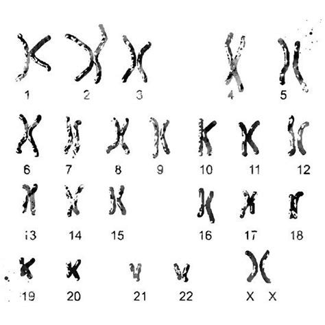 Female Chromosome idiogram | Chromosome, Female, Biology art