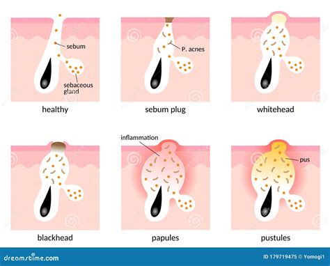 Acne Formation Process Skin Layer. Types of Acne. Healthy Skin, Sebum ...