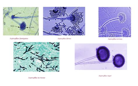 Aspergillosis » Clinical Laboratory Science