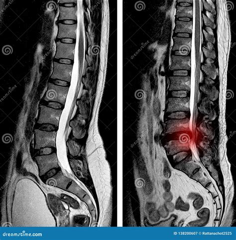 MRI Scan Sagittal View Lumbosacral Spine Has Straightening Lumbar ...