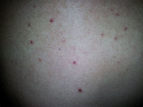 I Have Tiny Clusters Of Itchy Colorless Bumps On The Back Of | Images ...