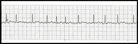 Float Nurse: Practice EKG Rhythm Strips 164