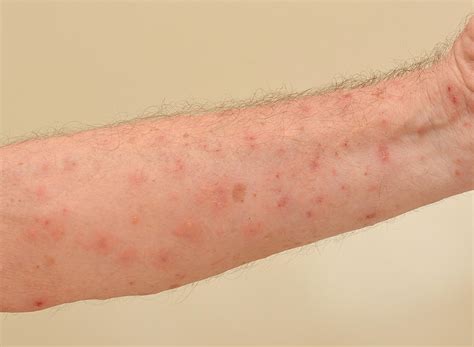 What Causes Scabies in Nursing Homes? | Scabies | My Nursing Home Lawyer