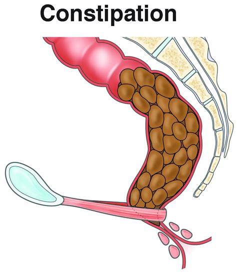 “Understanding Constipation: Causes and Prevention” – Constipation