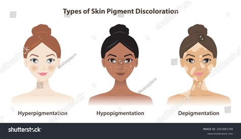 Types Skin Pigment Discoloration Vector Isolated Stock Vector (Royalty ...