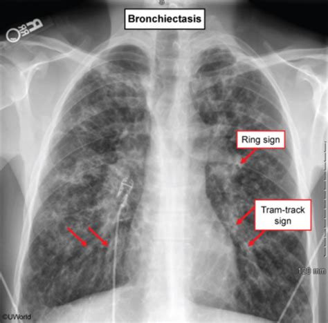 Bronchiectasis X Ray Tram Track