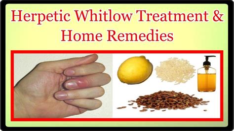 Herpetic Whitlow Treatment & Home Remedies - YouTube