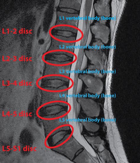 How To Understand Your Complex Spine MRI in 8 Easy Steps | Healthcare ...