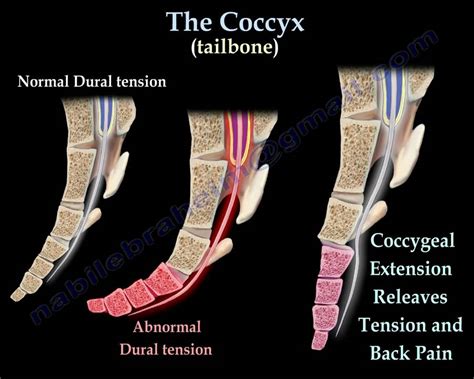 Coccyx, Tailbone pain /coccydynia - Everything You Need To Know - Dr ...