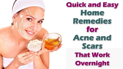 Quick Easy Home Remedies for Acne and Scars That Work Overnight - YouTube